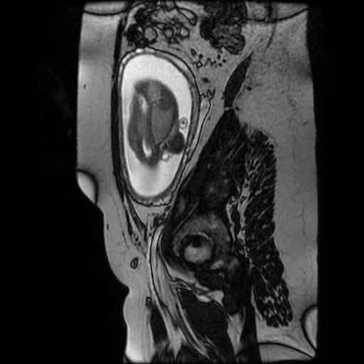 Chiari II malformation - fetal MRI (Radiopaedia 68099-77581 Sagittal Fiesta 12).jpg