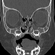 Choanal atresia (Radiopaedia 88525-105975 Coronal bone window 32).jpg