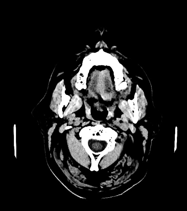 Cholangiocarcinoma with cerebral metastases (Radiopaedia 83519-98628 Axial non-contrast 1).jpg