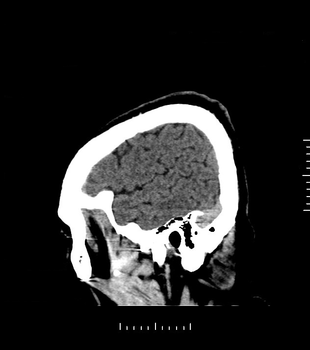 Cholangiocarcinoma with cerebral metastases (Radiopaedia 83519-98628 C 48).jpg