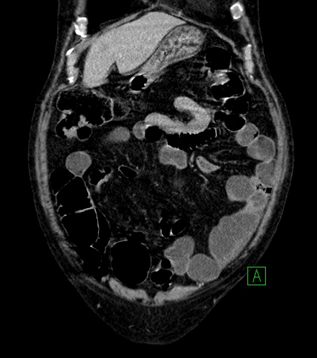 Cholangiocarcinoma with cerebral metastases (Radiopaedia 83519-98629 G 18).jpg
