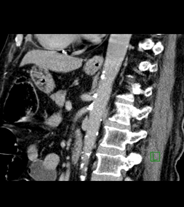 Cholangiocarcinoma with cerebral metastases (Radiopaedia 83519-98629 Sagittal C+ delayed 50).jpg
