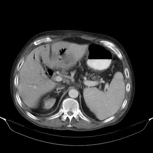 File:Cholangitis and abscess formation in a patient with cholangiocarcinoma (Radiopaedia 21194-21100 A 15).jpg