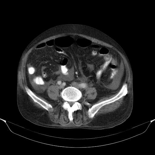 File:Cholangitis and abscess formation in a patient with cholangiocarcinoma (Radiopaedia 21194-21100 A 34).jpg
