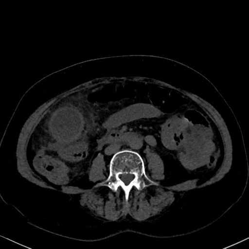 File:Cholecystitis - obstructive choledocholitiasis (CT intravenous cholangiography) (Radiopaedia 43966-47479 Axial 144).png