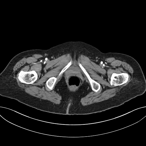 File:Cholecystoduodenal fistula due to calculous cholecystitis with gallstone migration (Radiopaedia 86875-103077 A 78).jpg