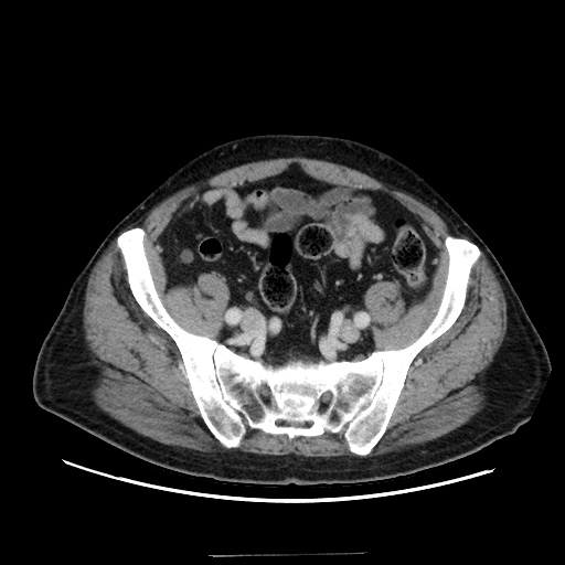 Choledocholiathiasis with normal caliber common bile duct (Radiopaedia 75368-86632 A 148).jpg