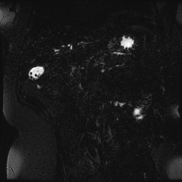 Choledocholithiasis on CT and MRI (Radiopaedia 24825-25088 Coronal T2 63).jpg