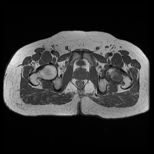 File:Chondroblastoma (Radiopaedia 12264-12564 Axial T1 3).jpg