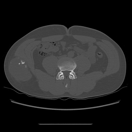 File:Chondrosarcoma of iliac wing (Radiopaedia 63861-72599 Axial bone window 19).jpg