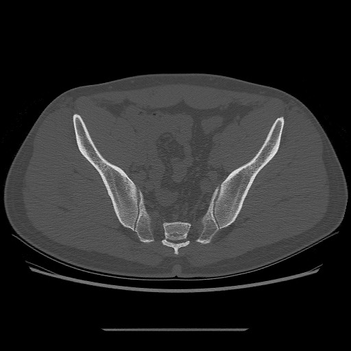 File:Chondrosarcoma of iliac wing (Radiopaedia 63861-72599 Axial bone window 72).jpg