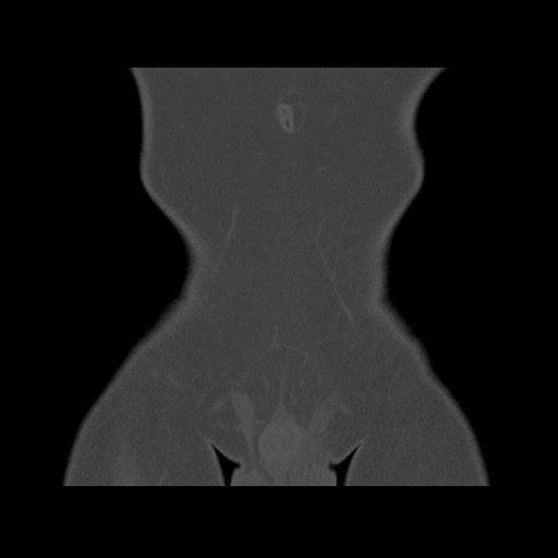 Chondrosarcoma of iliac wing (Radiopaedia 63861-72599 Coronal bone window 18).jpg