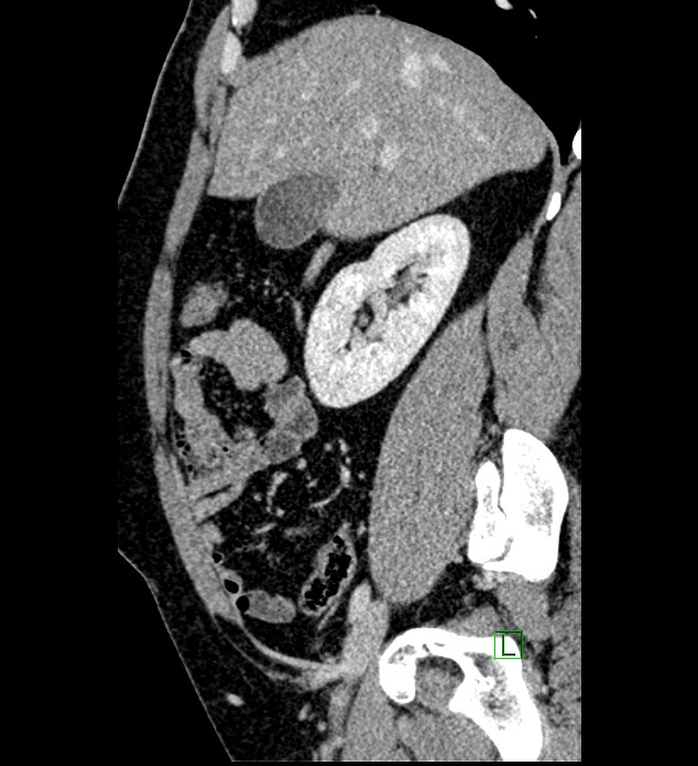 Chromophobe renal cell carcinoma (Radiopaedia 84286-99573 I 127).jpg