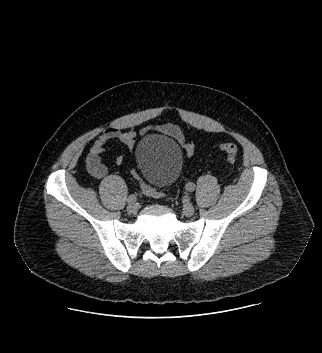 Chromophobe renal cell carcinoma (Radiopaedia 84337-99693 Axial non-contrast 121).jpg