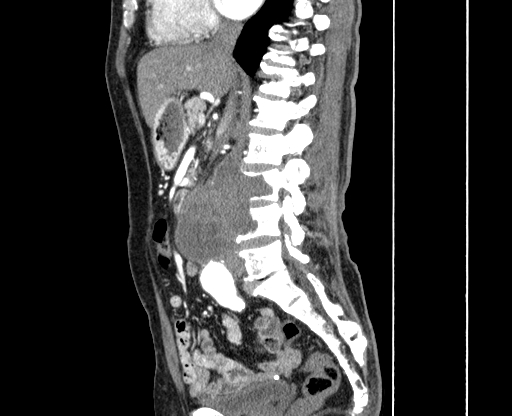 File:Chronic contained rupture of abdominal aortic aneurysm with extensive erosion of the vertebral bodies (Radiopaedia 55450-61901 B 24).jpg