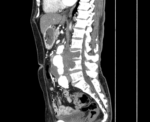 Chronic contained rupture of abdominal aortic aneurysm with extensive erosion of the vertebral bodies (Radiopaedia 55450-61901 B 28).jpg