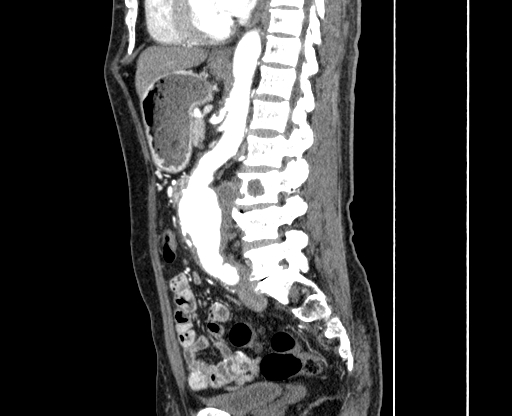 Chronic contained rupture of abdominal aortic aneurysm with extensive erosion of the vertebral bodies (Radiopaedia 55450-61901 B 39).jpg