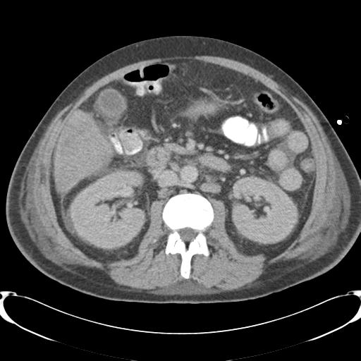 Chronic diverticulitis complicated by hepatic abscess and portal vein thrombosis (Radiopaedia 30301-30938 A 45).jpg