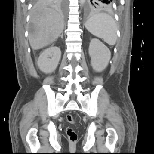 Chronic diverticulitis complicated by hepatic abscess and portal vein thrombosis (Radiopaedia 30301-30938 B 43).jpg