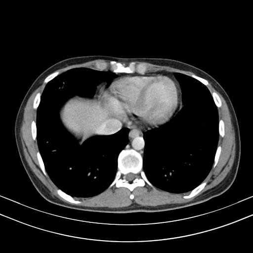 Chronic eosinophilic pneumonia (Radiopaedia 39331-41587 Axial C+ delayed 81).png