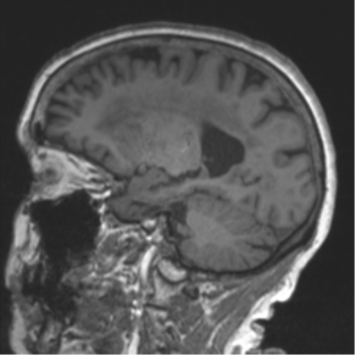 Chronic hypertensive encephalopathy (Radiopaedia 39993-42482 Sagittal T1 37).png