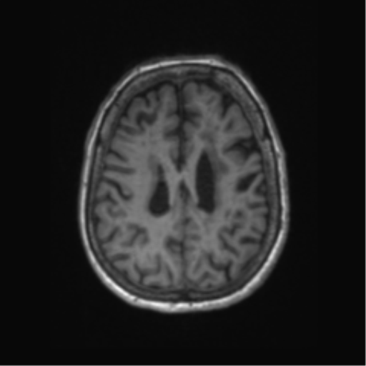Chronic hypertensive encephalopathy (Radiopaedia 72844-83495 Axial T1 23).png