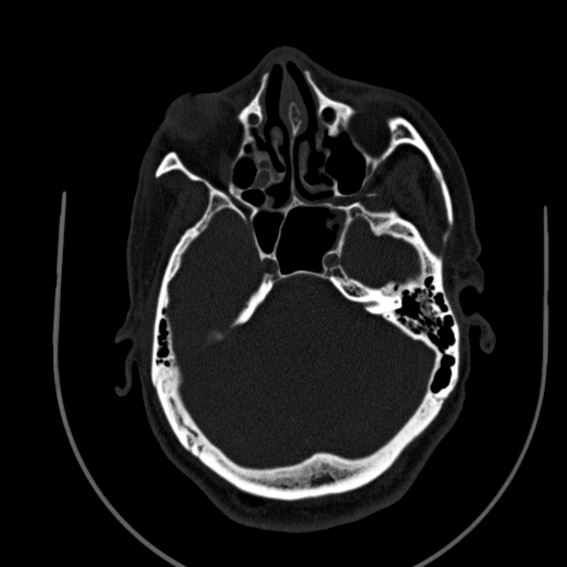 Chronic invasive fungal sinusitis (Radiopaedia 91563-109286 Axial sinus 58).jpg