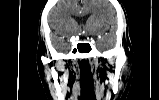 Chronic invasive fungal sinusitis (Radiopaedia 91563-109286 D 105).jpg