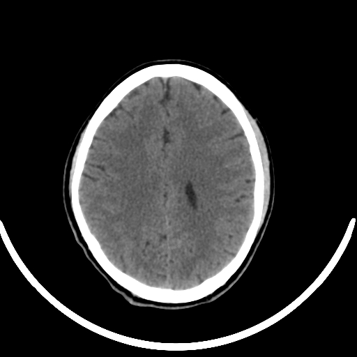 File:Chronic invasive fungal sinusitis with intraorbital and intracranial extension (Radiopaedia 56387-63046 Axial non-contrast 248).jpg