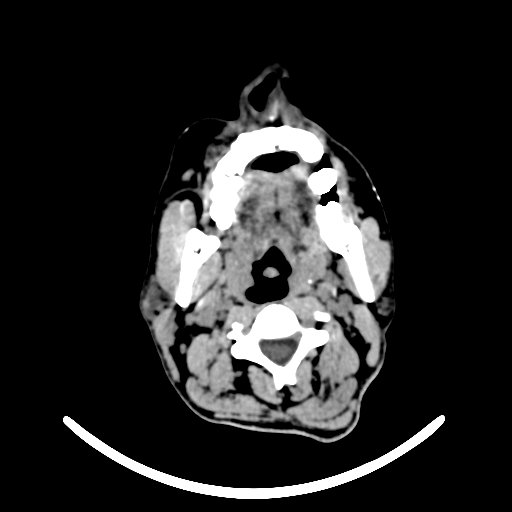 Chronic invasive fungal sinusitis with intraorbital and intracranial extension (Radiopaedia 56387-63046 Axial non-contrast 3).jpg