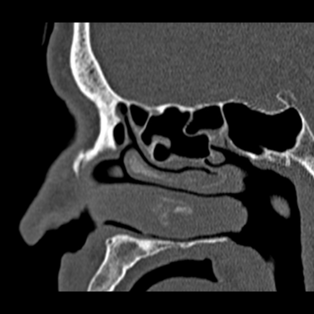 Chronic maxillary sinusitis (Radiopaedia 27879-28116 Sagittal bone window 32).jpg