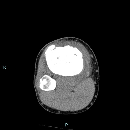 Chronic osteomyelitis (with Brodie abscess) (Radiopaedia 76405-88111 A 78).jpg