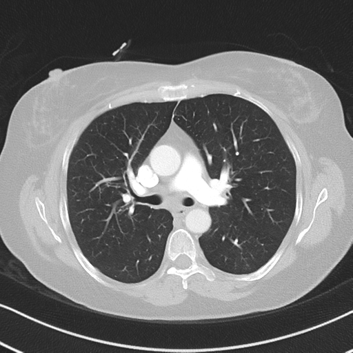 Chronic pulmonary embolus (Radiopaedia 39129-41341 Axial lung window 27).png