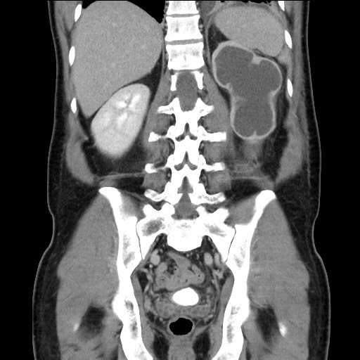 Chronic ureteropelvic junction obstruction (Radiopaedia 78365-90996 B 73).jpg