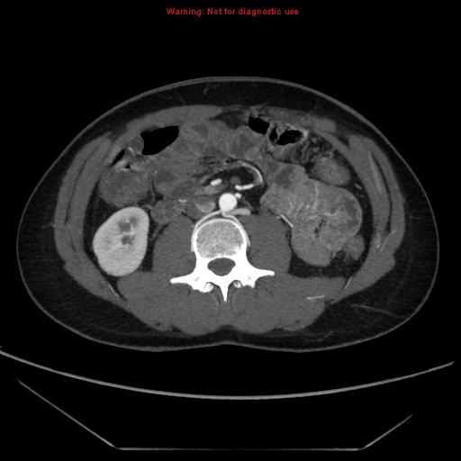 File:Circumaortic left renal vein (Radiopaedia 9069-9792 A 34).jpg
