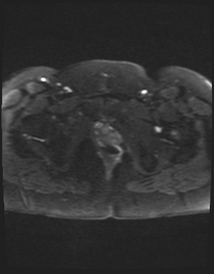 Class II Mullerian duct anomaly- unicornuate uterus with rudimentary horn and non-communicating cavity (Radiopaedia 39441-41755 Axial DWI 25).jpg