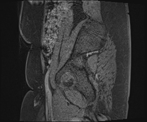 File:Class II Mullerian duct anomaly- unicornuate uterus with rudimentary horn and non-communicating cavity (Radiopaedia 39441-41755 G 119).jpg