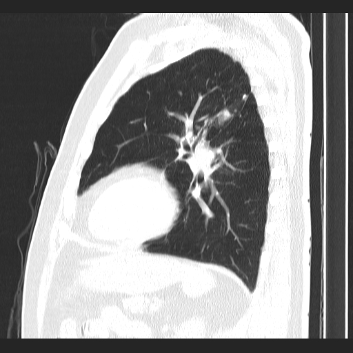 Classic complicated silicosis (Radiopaedia 49720-54961 Sagittal lung window 20).jpg