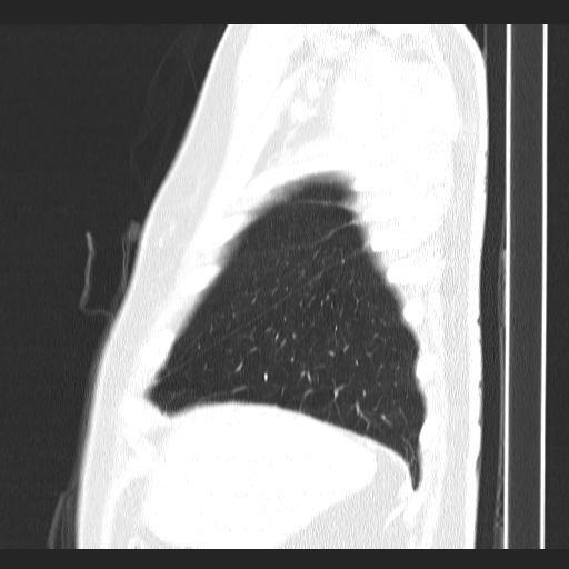 File:Classic complicated silicosis (Radiopaedia 49720-54961 Sagittal lung window 54).jpg