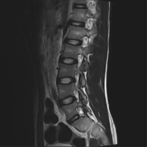 File:Clear cell meningoma - lumbar spine (Radiopaedia 60116-67690 Sagittal T2 5).png