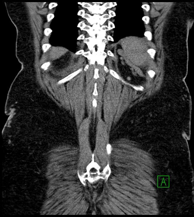 Closed-loop small bowel obstruction-internal hernia (Radiopaedia 78439-91096 Coronal non-contrast 87).jpg