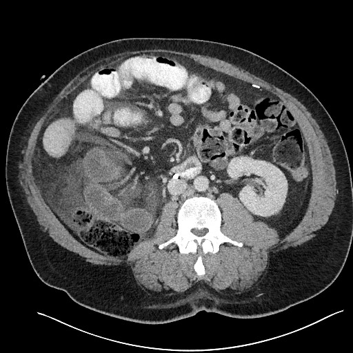 File:Closed loop obstruction - internal hernia into nephrectomy bed (Radiopaedia 59867-67320 Axial 3).jpg