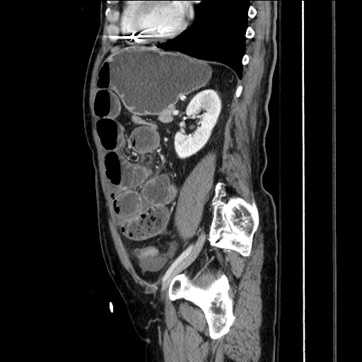 Closed loop obstruction due to adhesive band, resulting in small bowel ischemia and resection (Radiopaedia 83835-99023 F 122).jpg