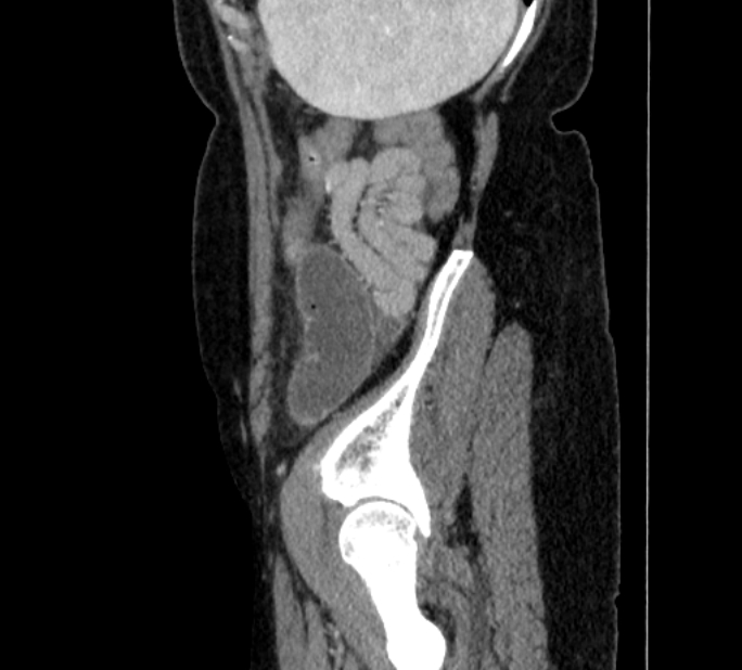 Closed loop small bowel obstruction (Radiopaedia 71211-81508 C 146).jpg