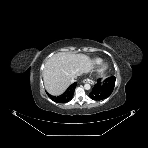 Closed loop small bowel obstruction - internal hernia (Radiopaedia 65402-74450 A 11).jpg