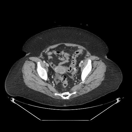 Closed loop small bowel obstruction - internal hernia (Radiopaedia 65402-74450 A 113).jpg