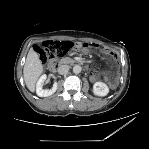 File:Closed loop small bowel obstruction - omental adhesion causing "internal hernia" (Radiopaedia 85129-100682 A 66).jpg