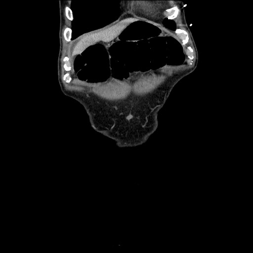 File:Closed loop small bowel obstruction - omental adhesion causing "internal hernia" (Radiopaedia 85129-100682 B 24).jpg