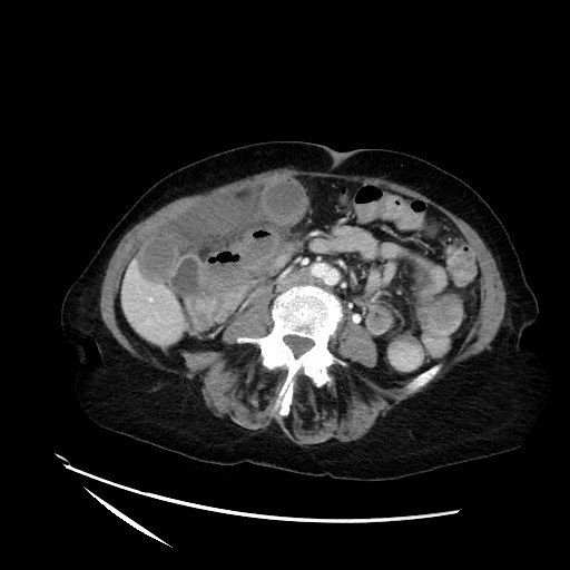 File:Closed loop small bowel obstruction due to adhesive band, with intramural hemorrhage and ischemia (Radiopaedia 83831-99017 Axial 5).jpg