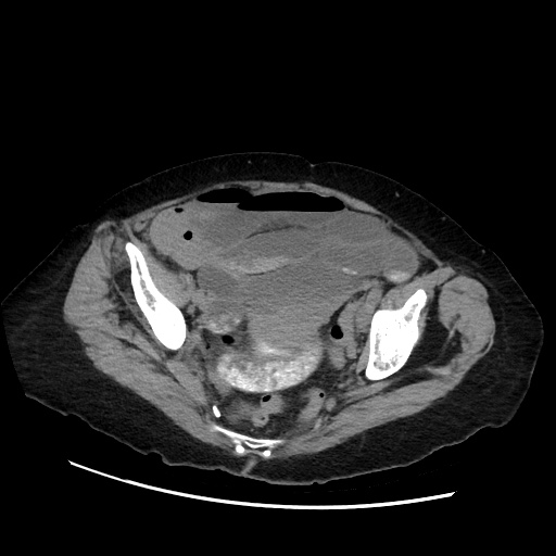 Closed loop small bowel obstruction due to adhesive band, with intramural hemorrhage and ischemia (Radiopaedia 83831-99017 Axial non-contrast 134).jpg